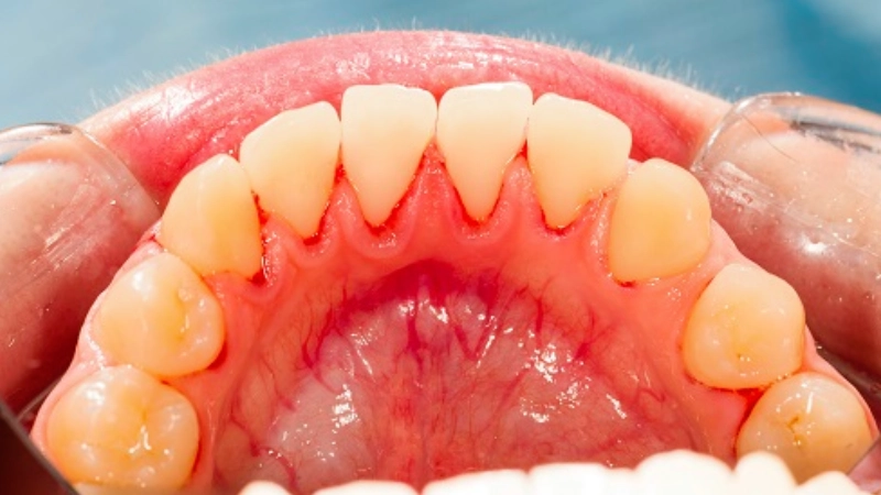 Complications of Neglected Gingivitis on Oral and General Health