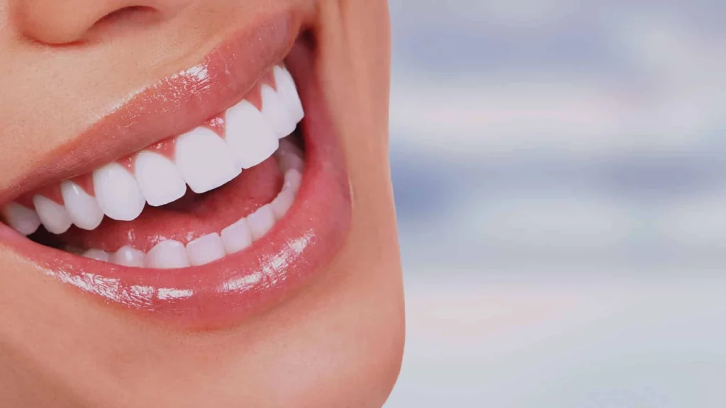 العدسات اللاصقة للأسنان