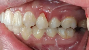 تراجع اللثة