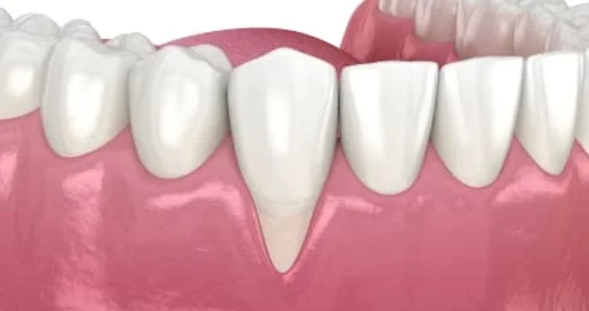Gum Recession