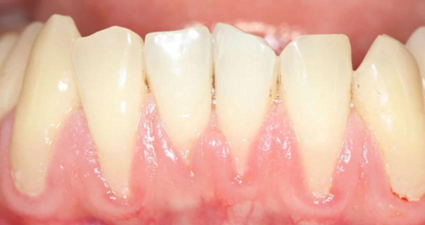 Conventional Treatment Options for Gum Recession