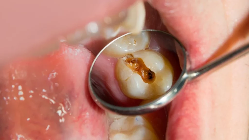 تسوس الأسنان العميق