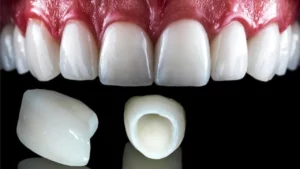 الفرق بين قشور الإيماكس والبورسلين