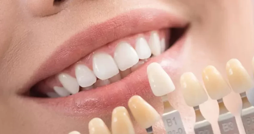 Emax Veneers vs Porcelain Veneers