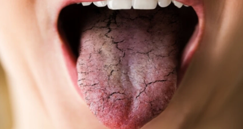 What is dry mouth and why does it occur?
