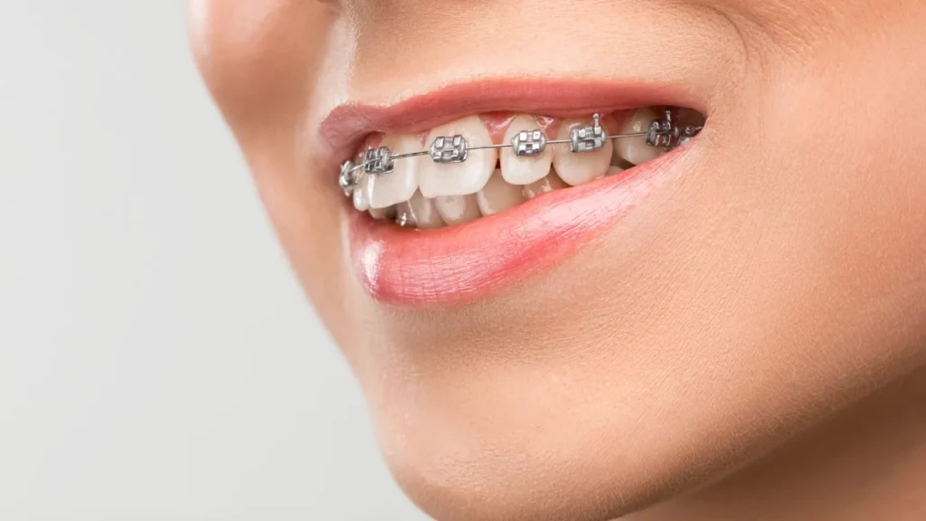 تقويم الأسنان في جدة