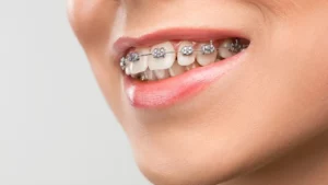 تقويم الأسنان في جدة