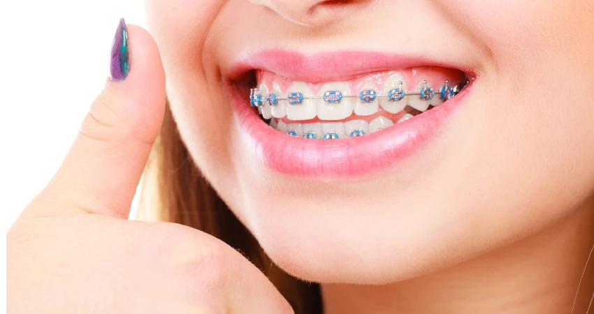 Orthodontic Treatment Cost in Saudi Arabia