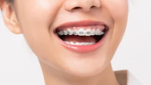 مدة علاج التقويم