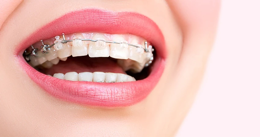 Orthodontic Treatment Duration