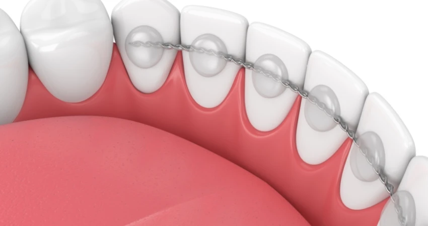 Who is a candidate for lingual braces, and who is better suited for traditional braces?