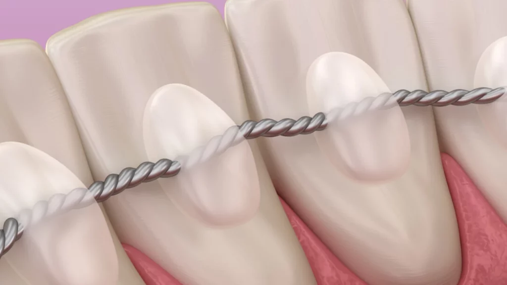 تقويم الأسنان الداخلي