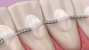 تقويم الأسنان الداخلي