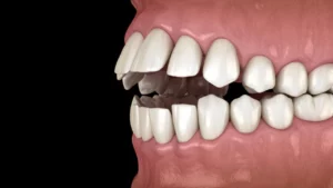 العضة المفتوحة الجانبية