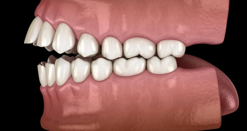 Tips to Prevent Worsening of a Lateral Open Bite
