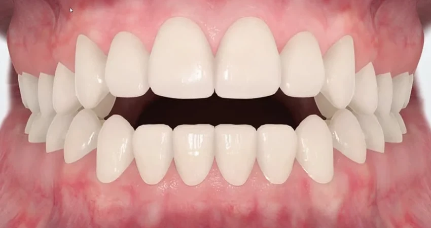 العضة المفتوحة الجانبية