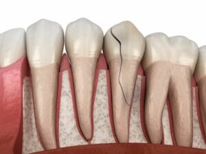 Causes of tooth cracks: Why do cracks occur and how to avoid them? A comprehensive guide (2026)
