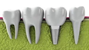 Laser Dental Implants – A Comprehensive Guide
