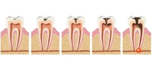 Stages of tooth decay in detail: Symptoms and treatment for each stage | Comprehensive guide 2026
