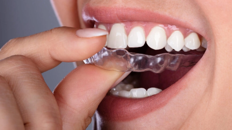 When Are Clear Aligners Not the Best Option?