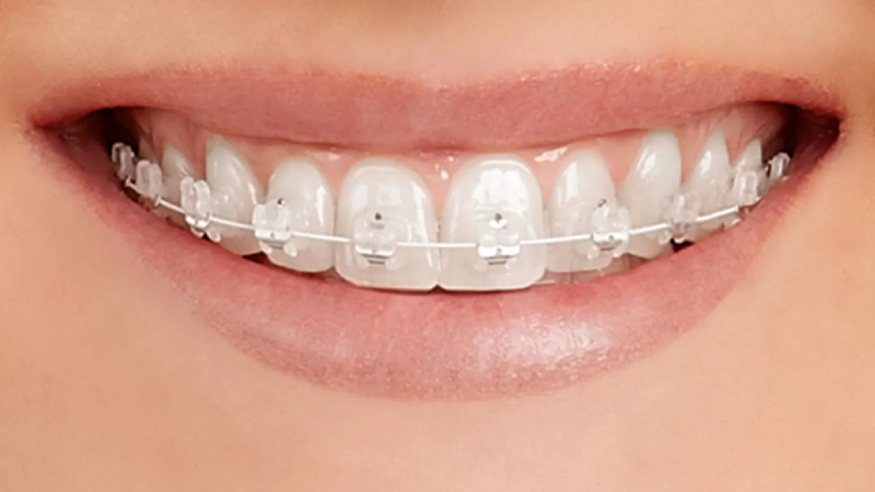Does Skipping Regular Orthodontic Appointments Affect the Result?