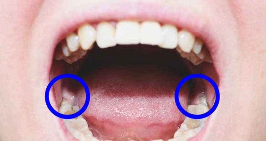 How Does the Dentist Diagnose an Impacted Wisdom Tooth?