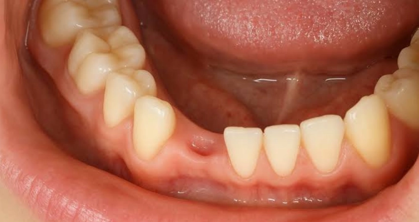 Small Teeth