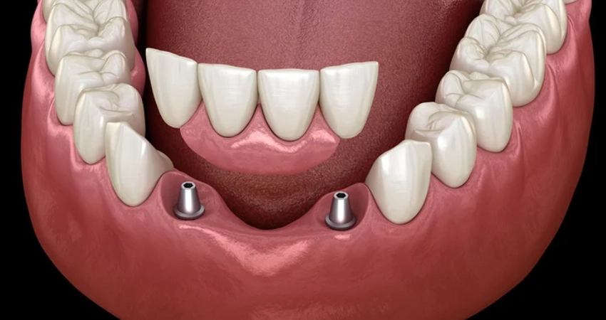 Front Tooth Dental Implant