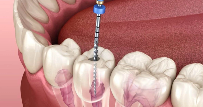 Dental crown after root canal