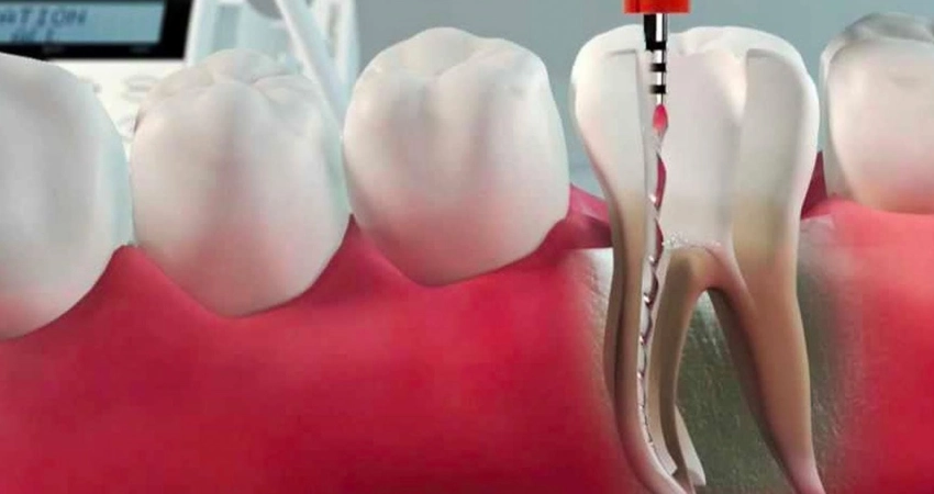 What Happens If You Do Not Get a Crown After a Root Canal?