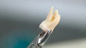 خلع الأسنان قبل التقويم