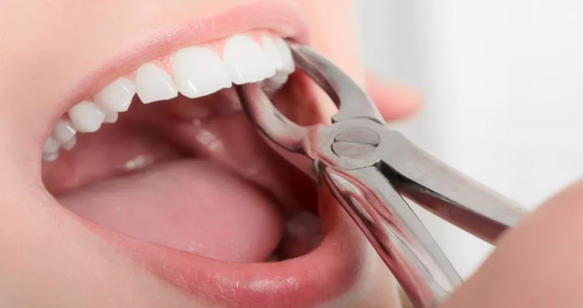 Tooth extraction before braces
