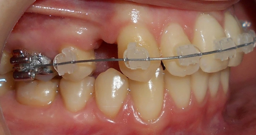 Dental midline deviation