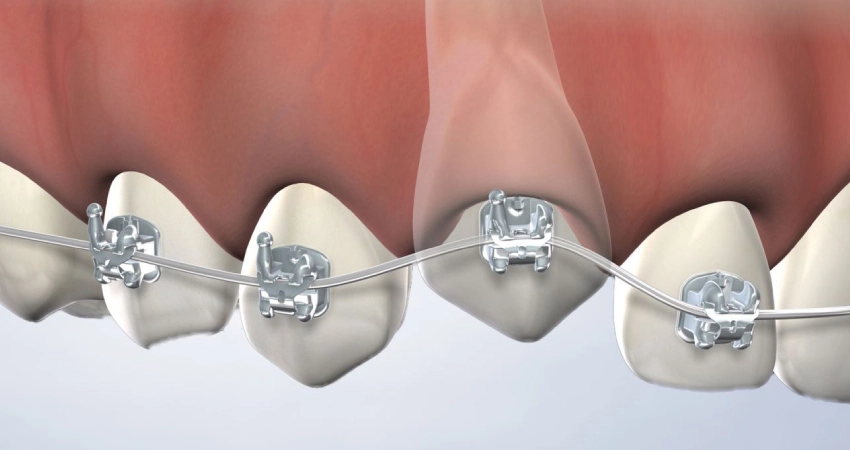 Impacted Canine Tooth